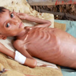 La malnutrition