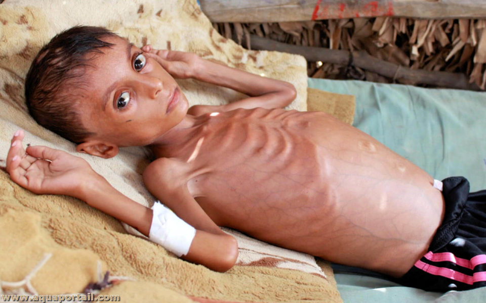 La malnutrition