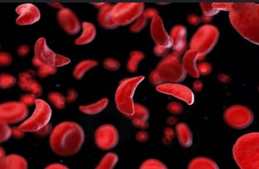 Drépanocytose